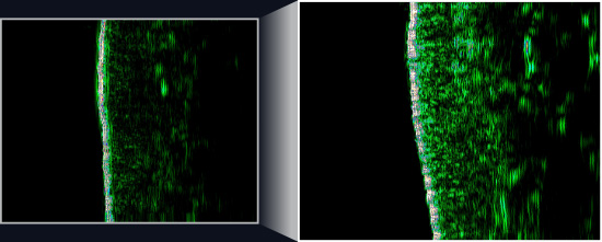 사용 전에 비해 사용 후 피부 치밀도가 개선된 모습