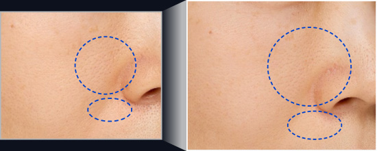 사용 전에 비해 사용 후 노화 모공 비교