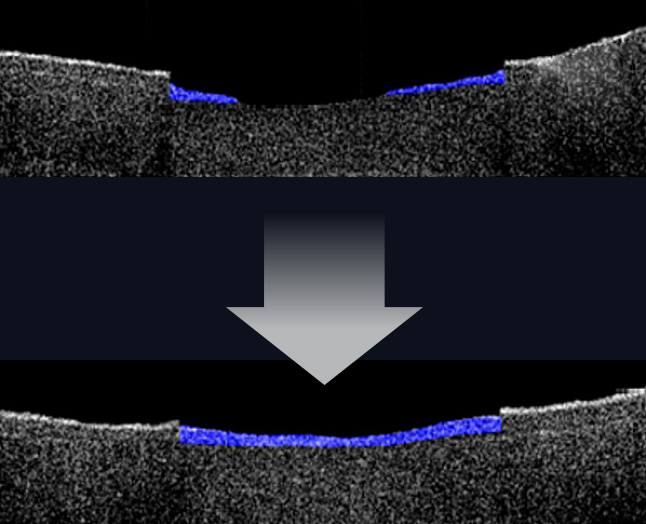 아이오페 처방레티놀 사용 전과 후의 스킨 리뉴잉 효과 비교 측정