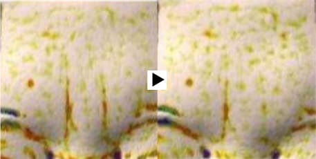 미간 주름 제품 사용 전, 사용 2주 후 비교
