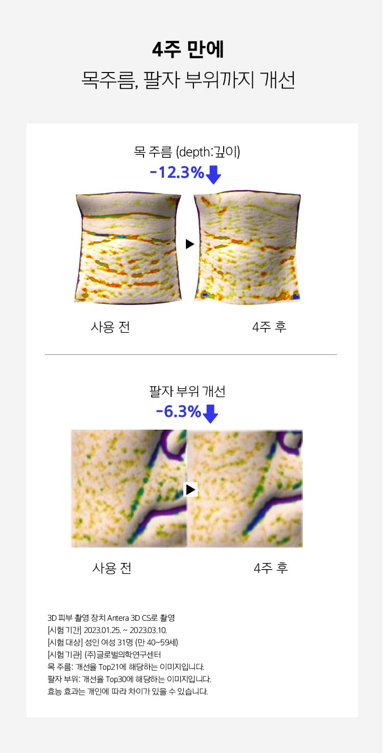 Improvement of neck wrinkles and nasolabial area in 4 weeks